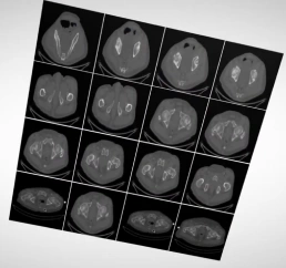 術前の3DCT撮影の様子