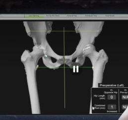 3D解析・手術計画の画面